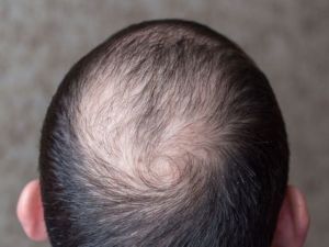 protesi capillare bio pelle