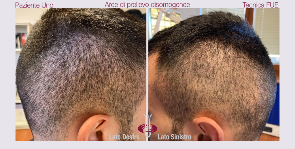 Autotrapianto FUE