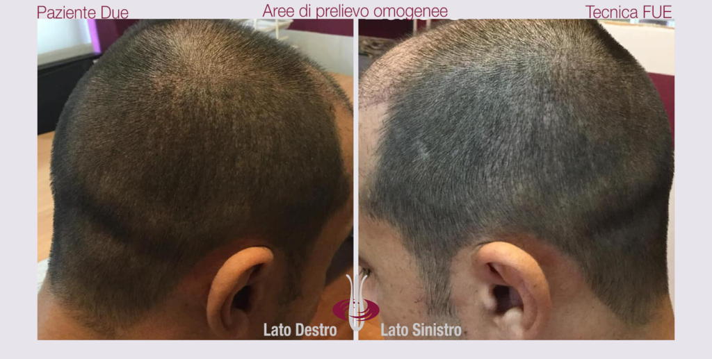 Autotrapianto FUE