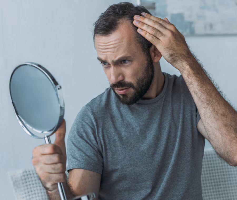 alopecia androgenetic