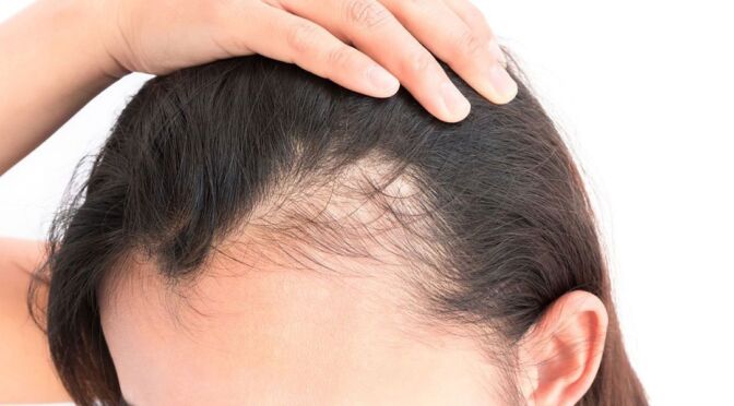 perditadeicapelli_stress-672x372