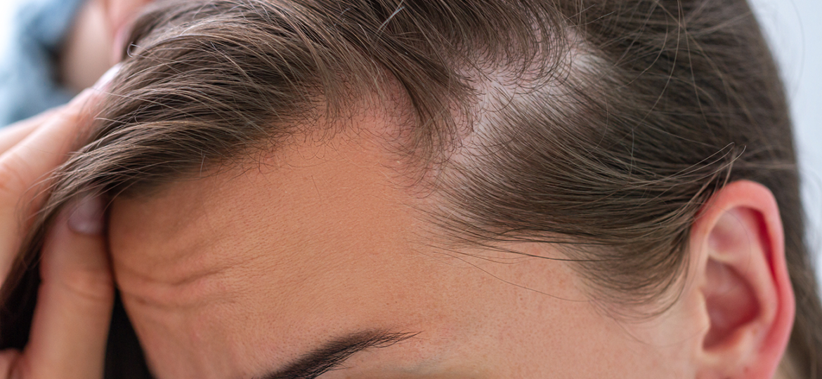 cause-e-sintomi-della-calvizie-femminile