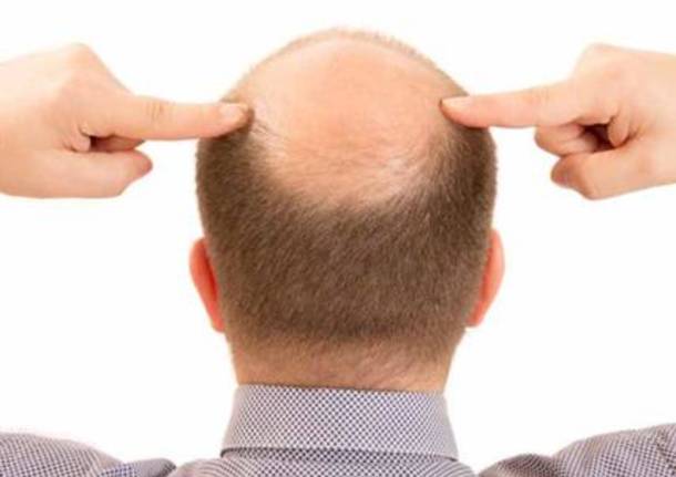 prevenzione calvizie